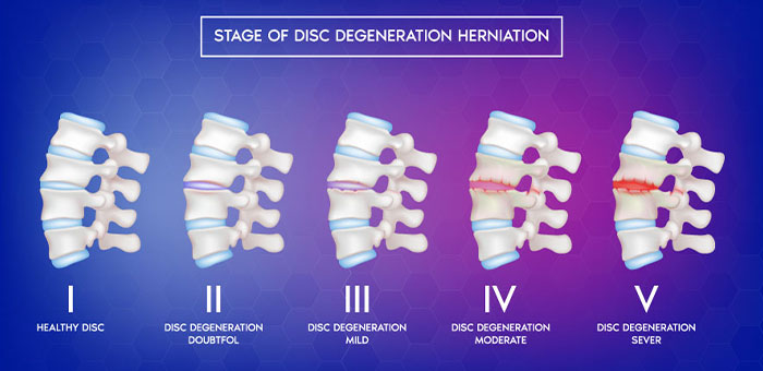 degenerative disc disease causes La Verne