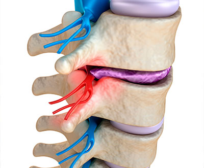 spinal decompression for pinched nerve in La Verne