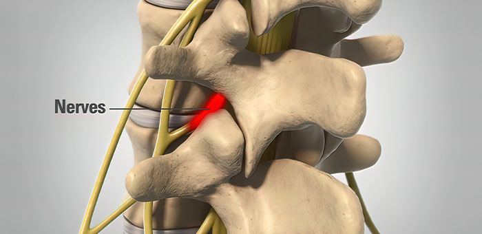 pinched nerve treatment in La Verne
