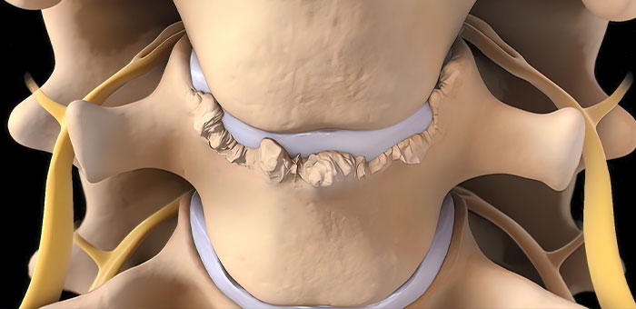 spinal-stenosis treatment in La Verne