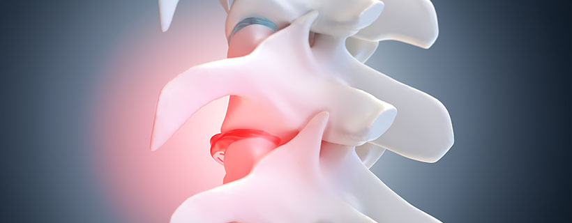 patient needing degenerative disc disease in need of spinal decompression therapy in La Verne