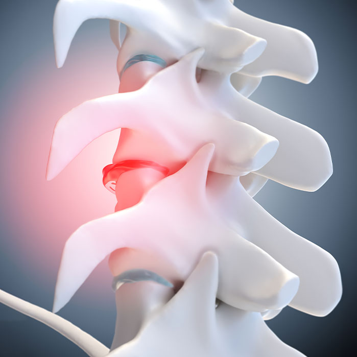 degenerative Disc Disease treatment in La Verne