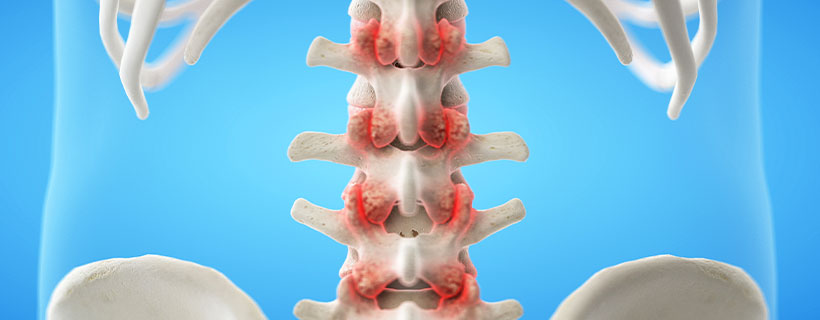 patient needing facet joint syndrome in need of spinal decompression therapy in La Verne