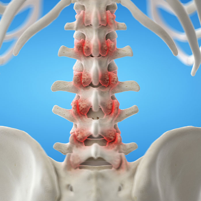 facet Joint Syndrome treatment in La Verne