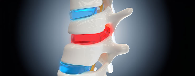 patient needing herniated disc in need of spinal decompression therapy in La Verne