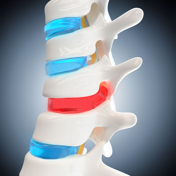 herniated Disc treatment in La Verne