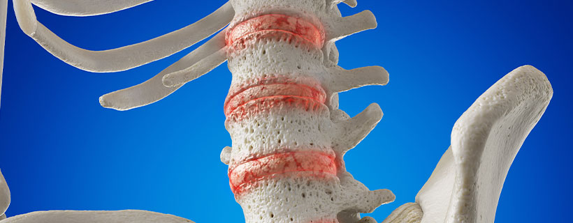 patient needing osteoarthritis in need of spinal decompression therapy in La Verne