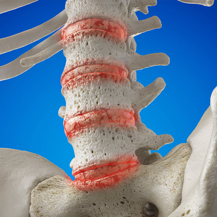 osteoarthritis treatment in La Verne