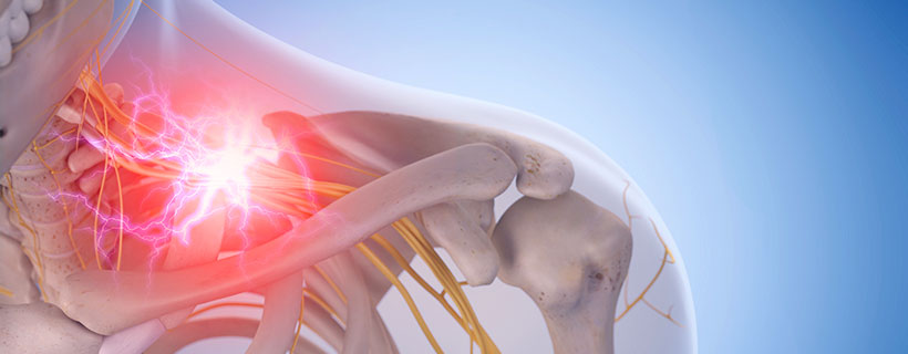 patient needing pinched nerve in need of spinal decompression therapy in La Verne