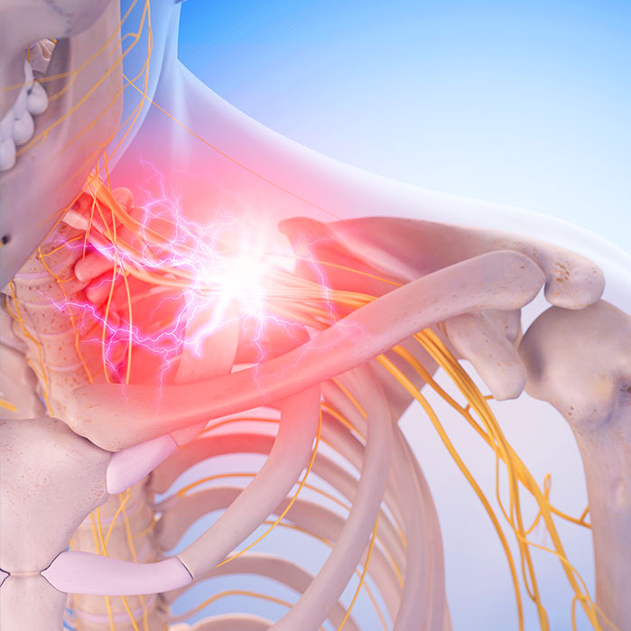 pinched nerve treatment in La Verne