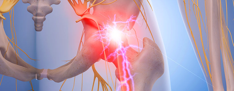 patient needing sciatica in need of spinal decompression therapy in La Verne