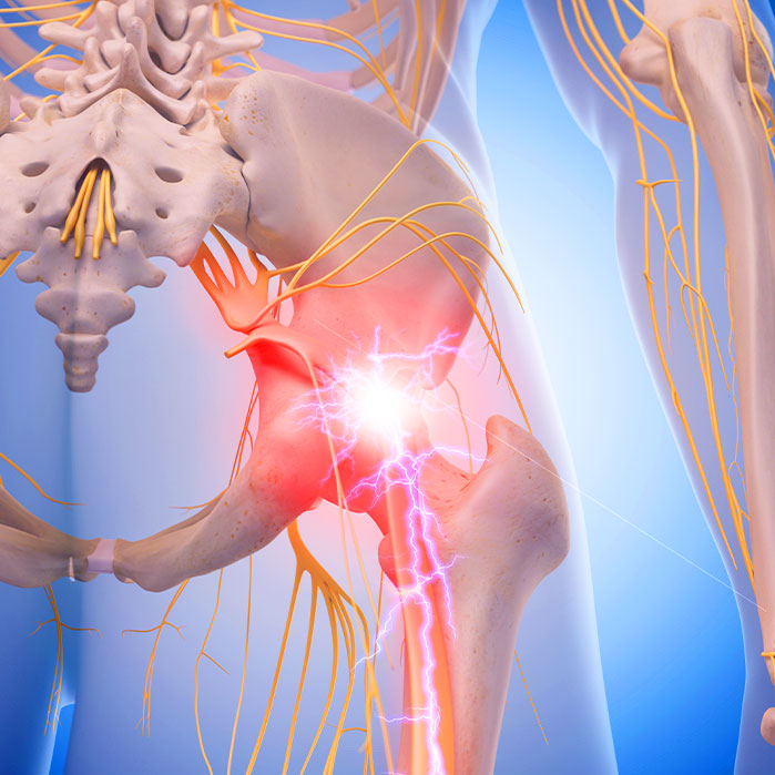 sciatica treatment in La Verne