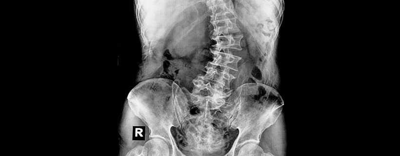 patient needing scoliosis in need of spinal decompression therapy in La Verne