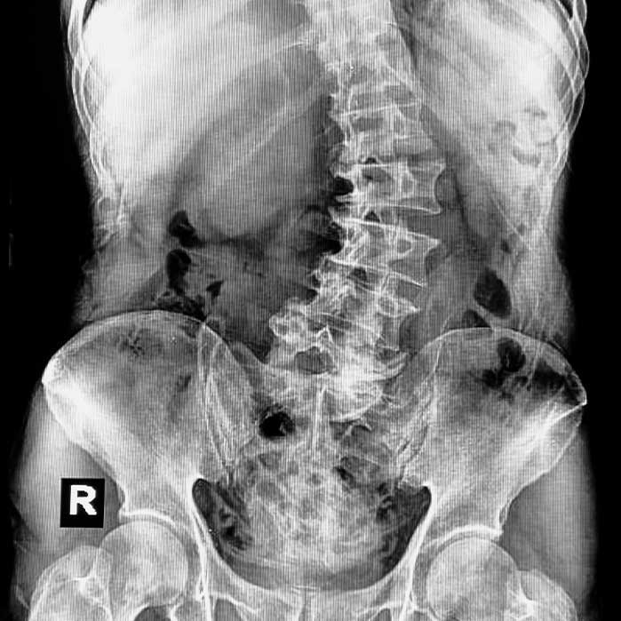 scoliosis treatment in La Verne