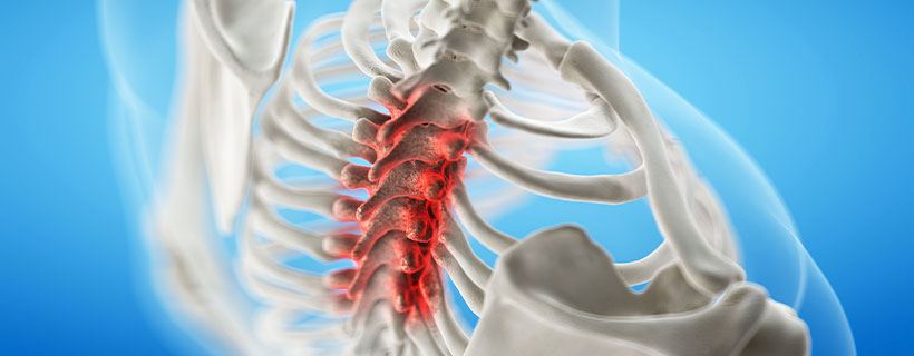 patient needing spinal stenosis in need of spinal decompression therapy in La Verne