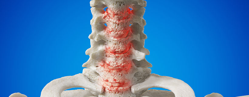 patient needing spondylosis  in need of spinal decompression therapy in La Verne