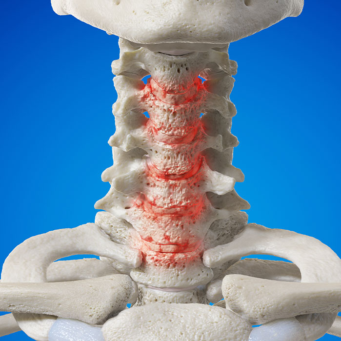spondylosis treatment in La Verne